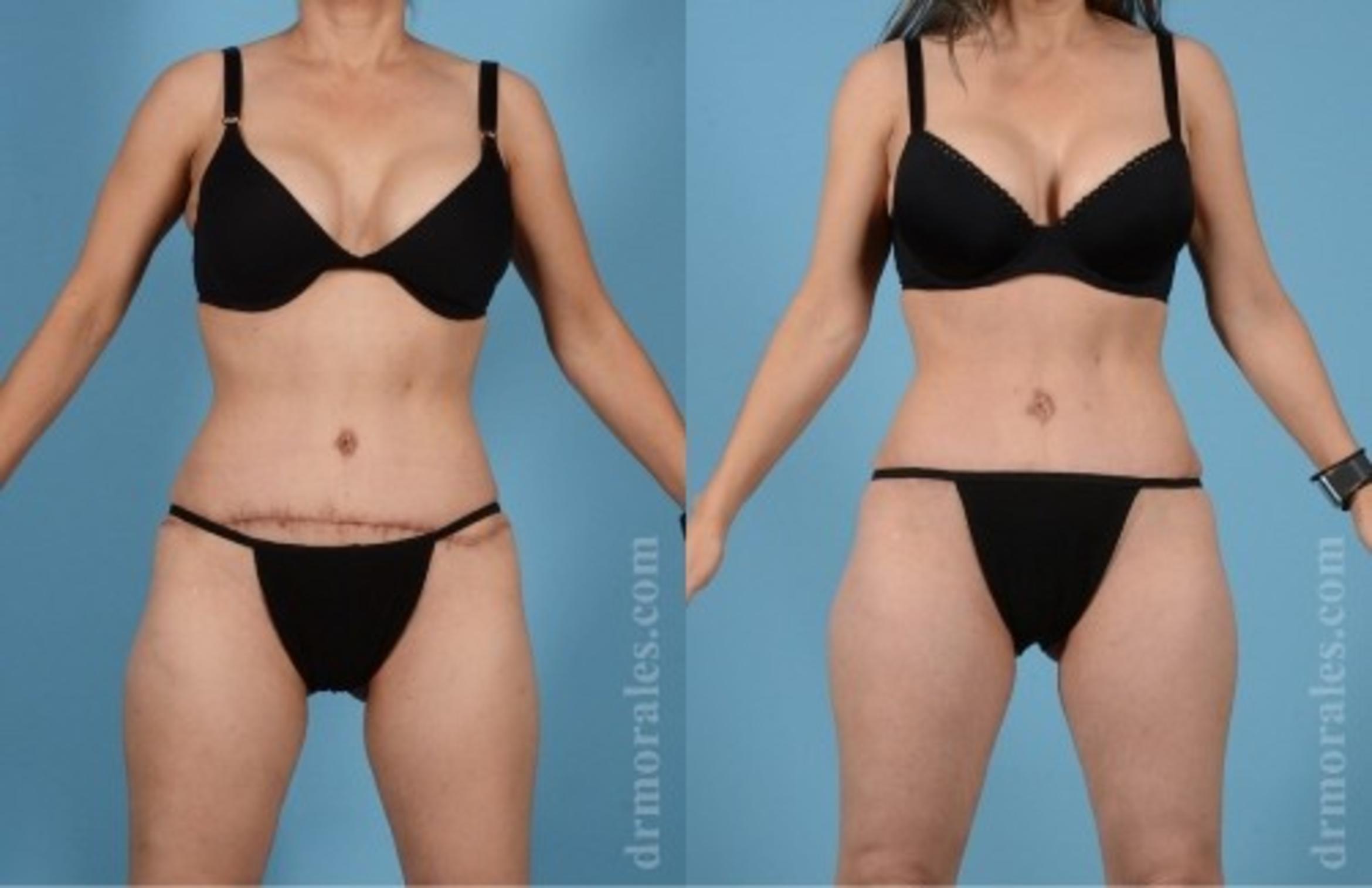 Before & After Tummy Tuck Case 571 View 1 View in Houston, TX