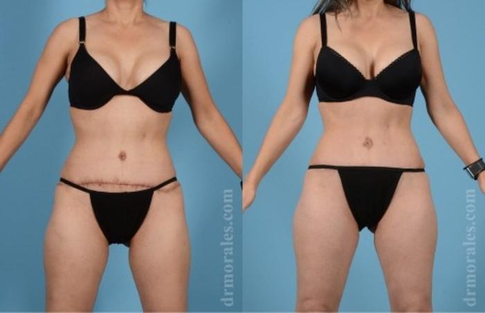 Before & After Tummy Tuck Case 571 View 1 View in Houston, TX